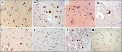 Heterogeneous Nuclear Ribonucleoprotein E2 (hnRNP E2) Is a Component of TDP-43 Aggregates Specifically in the A and C Pathological Subtypes of Frontotemporal Lobar Degeneration